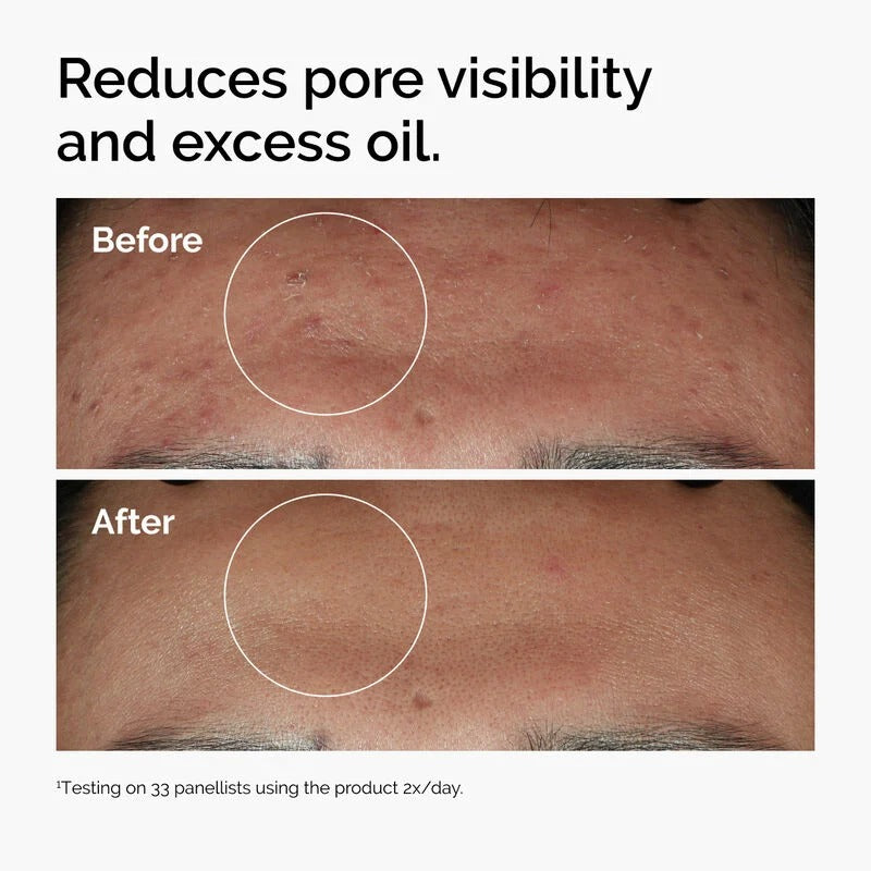 The Ordinary - Niacinamide 10% + Zinc 1%