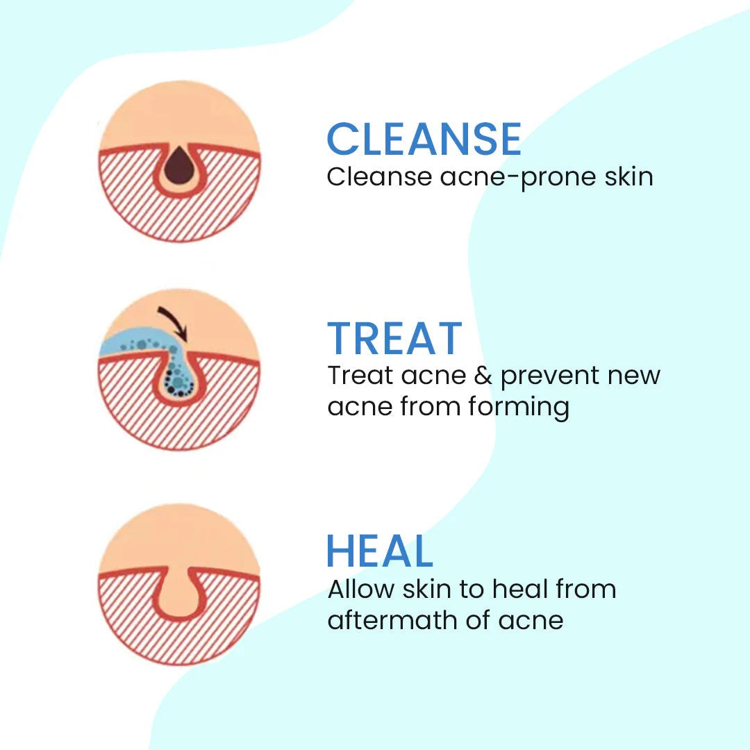 Vince - Anti Acne Cream