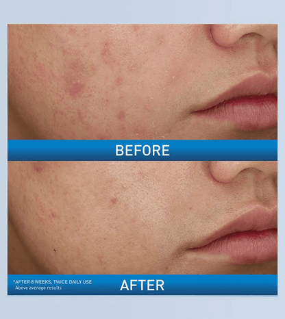 CeraVe - Acne Foaming Cream Wash