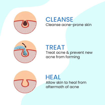 Vince - Anti Acne Cream